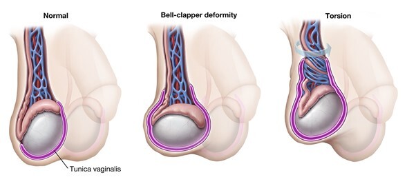 A diagram of a testicle with a spermatic cord and a bell clapper deformity