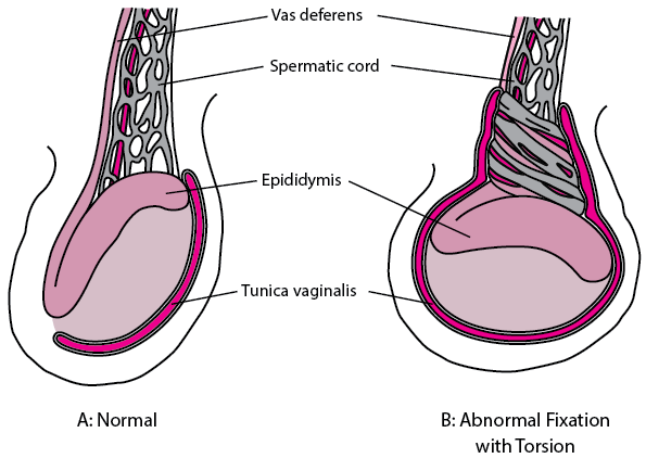 A diagram of testicular torsion showing the spermatic cord and the twisted testicle