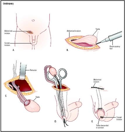 A medical illustration showing the process of Orchiopexy surgery for the prevention of twisting of the testicle