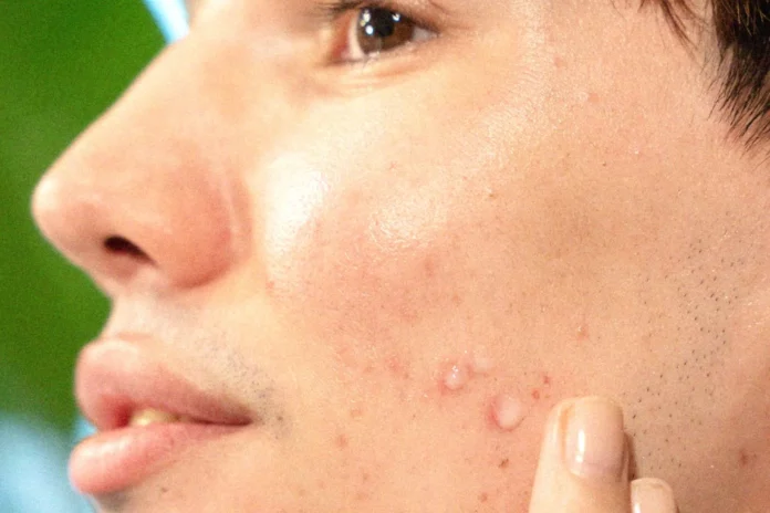 Acne Scars