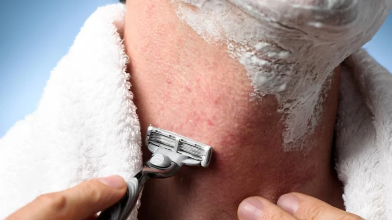 Prevention of Razor Bumps: Effective Strategies and Remedies